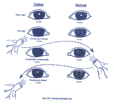 pupillary constriction